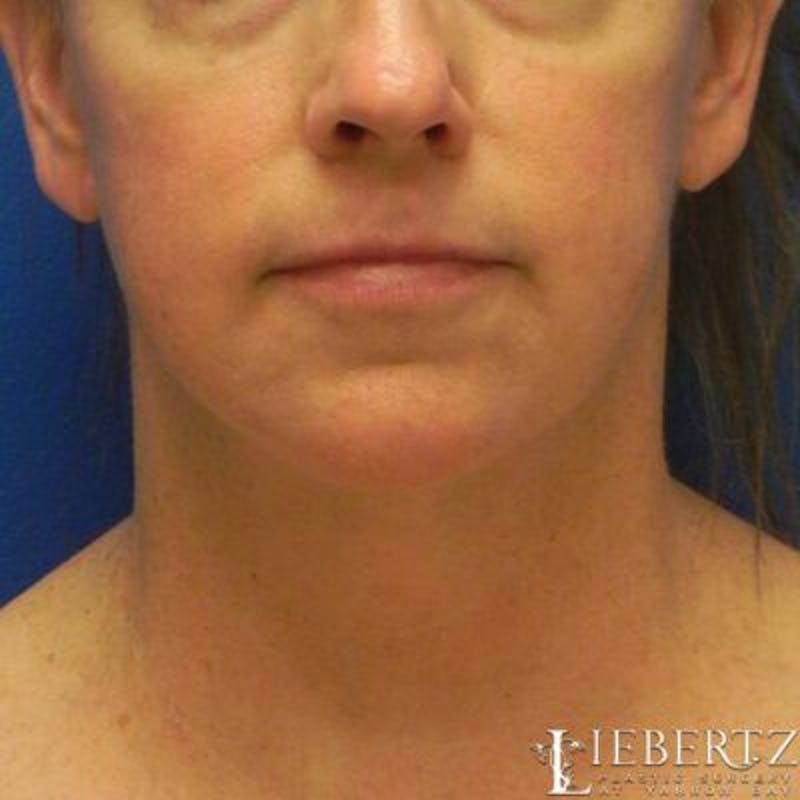 Facelift Before & After Gallery - Patient 711866 - Image 2