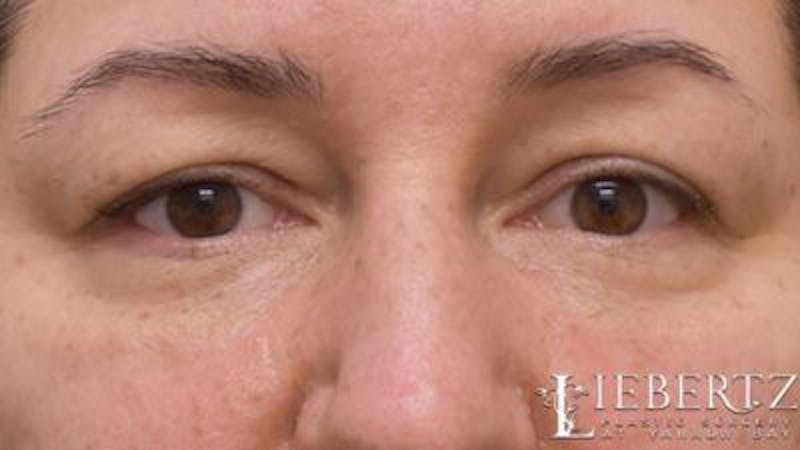Blepharoplasty Before & After Gallery - Patient 745456 - Image 3