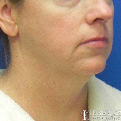 Facelift Before & After Gallery - Patient 711866 - Image 1