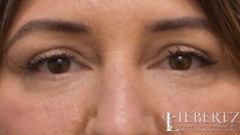 Blepharoplasty Before & After Gallery - Patient 745456 - Image 4