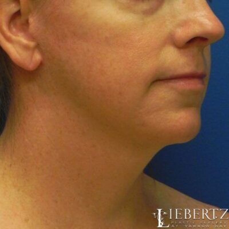 Facelift Before & After Gallery - Patient 711866 - Image 4
