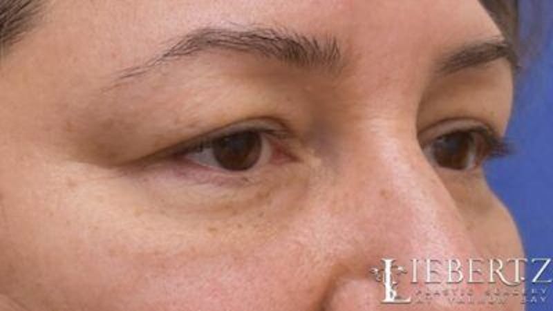 Blepharoplasty Before & After Gallery - Patient 745456 - Image 5