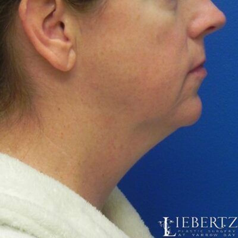 Facelift Before & After Gallery - Patient 711866 - Image 5