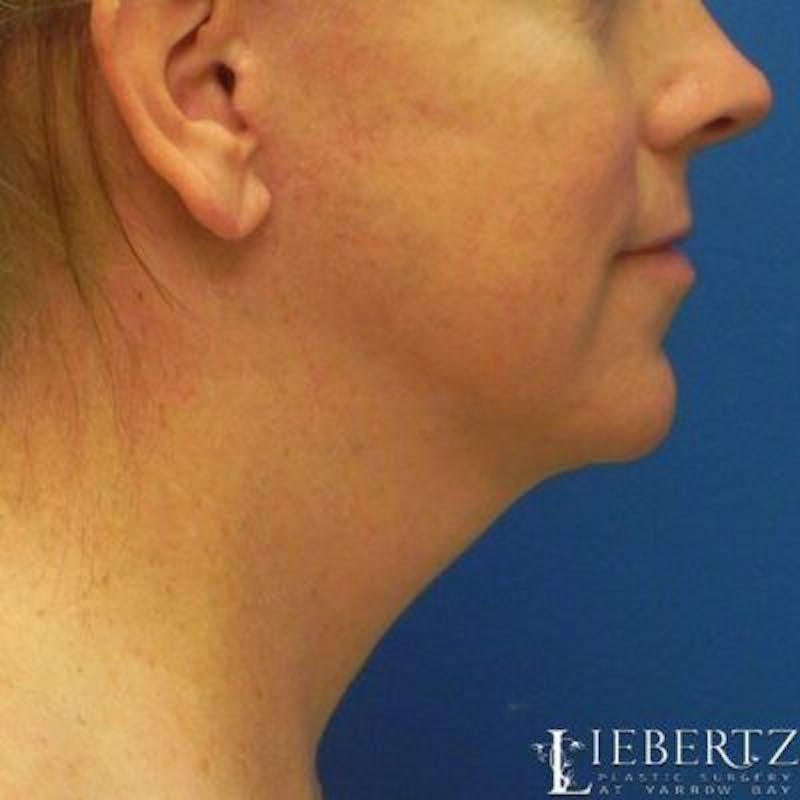 Facelift Before & After Gallery - Patient 711866 - Image 6