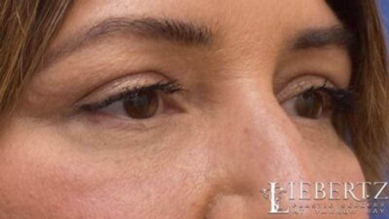 Blepharoplasty Before & After Gallery - Patient 745456 - Image 6