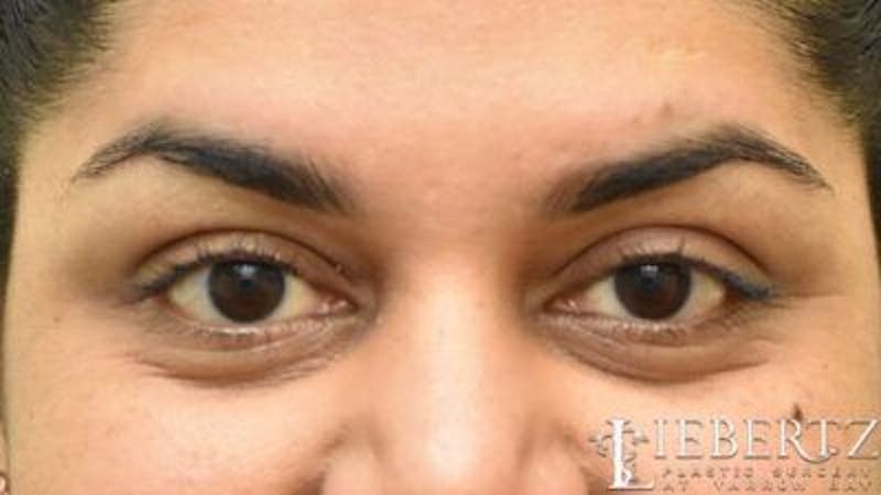 Wrinkle Relaxers Before & After Gallery - Patient 356210 - Image 1