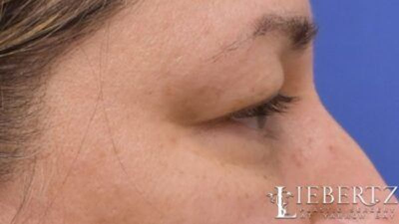 Blepharoplasty Before & After Gallery - Patient 745456 - Image 7