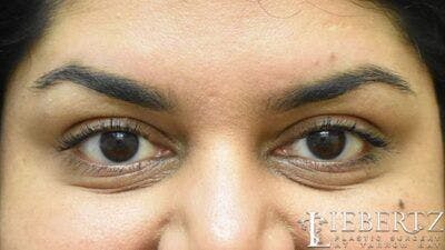 Wrinkle Relaxers Before & After Gallery - Patient 356210 - Image 2
