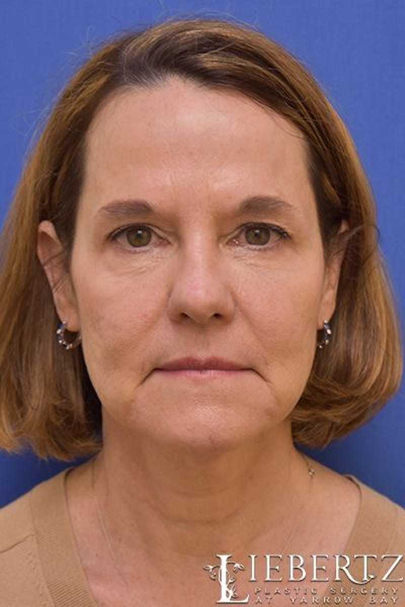 Facelift Before & After Gallery - Patient 390865 - Image 1