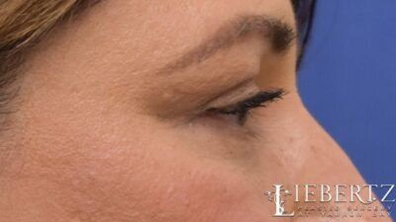 Blepharoplasty Before & After Gallery - Patient 745456 - Image 8