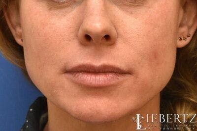 Lip Augmentation Before & After Gallery - Patient 311181 - Image 1