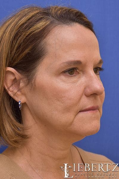 Facelift Before & After Gallery - Patient 390865 - Image 1