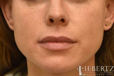 Lip Augmentation Before & After Gallery - Patient 311181 - Image 2