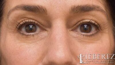 Blepharoplasty Before & After Gallery - Patient 320489 - Image 1