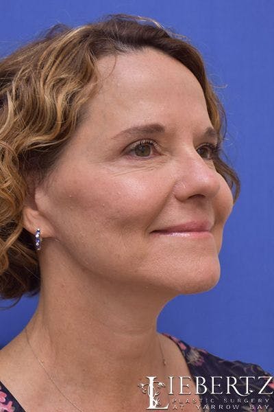 Facelift Before & After Gallery - Patient 390865 - Image 2