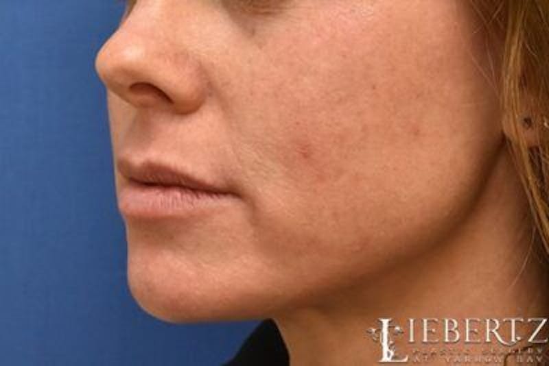 Dermal Fillers Before & After Gallery - Patient 312895 - Image 3
