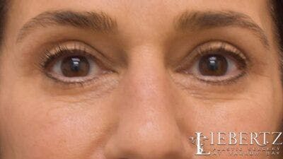 Blepharoplasty Before & After Gallery - Patient 320489 - Image 2