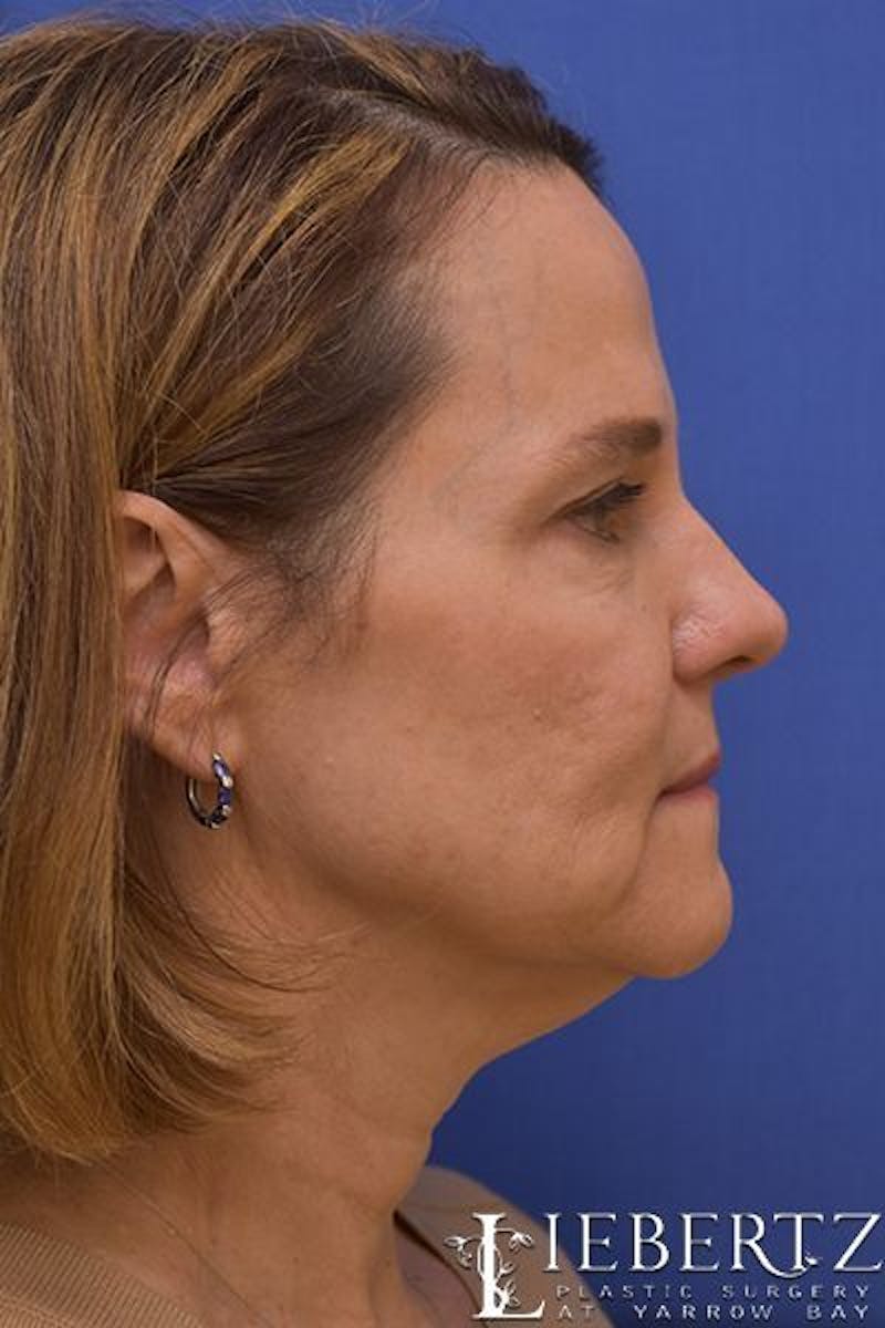 Facelift Before & After Gallery - Patient 390865 - Image 5
