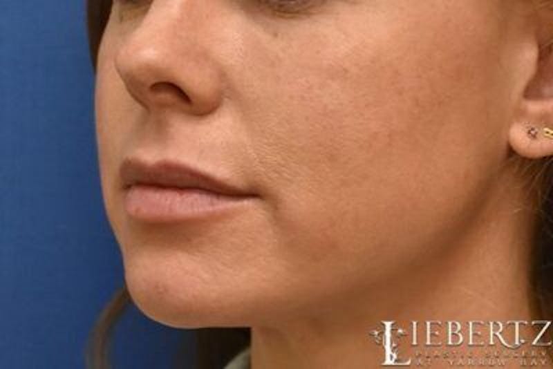 Dermal Fillers Before & After Gallery - Patient 312895 - Image 4