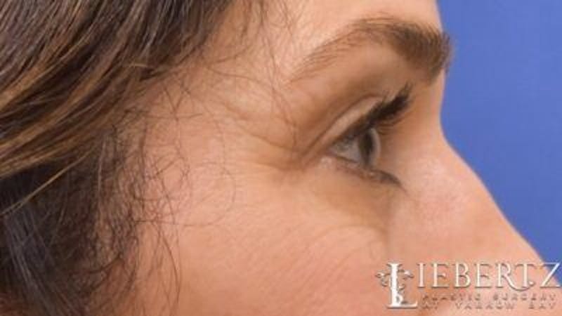 Blepharoplasty Before & After Gallery - Patient 320489 - Image 3
