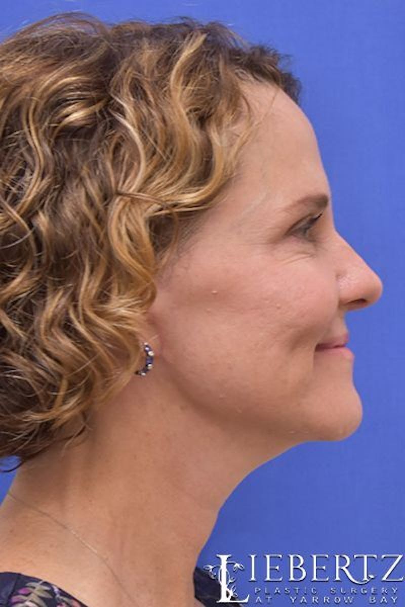 Facelift Before & After Gallery - Patient 390865 - Image 6