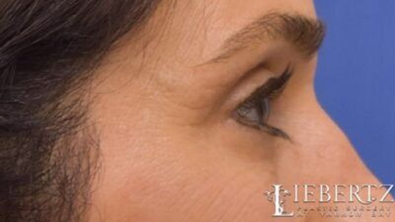 Blepharoplasty Before & After Gallery - Patient 320489 - Image 4