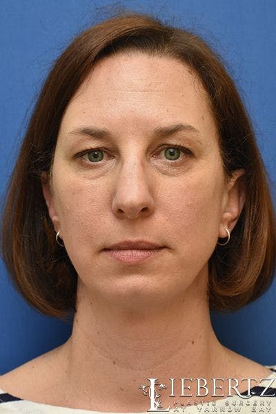 Dermal Fillers Before & After Gallery - Patient 295599 - Image 1