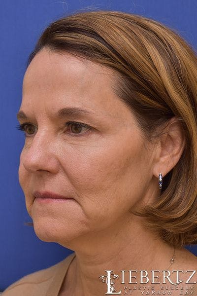 facelift