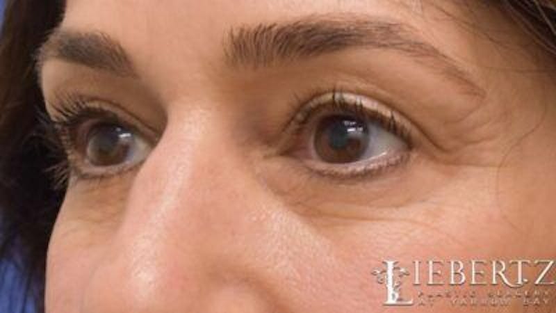 Blepharoplasty Before & After Gallery - Patient 320489 - Image 5