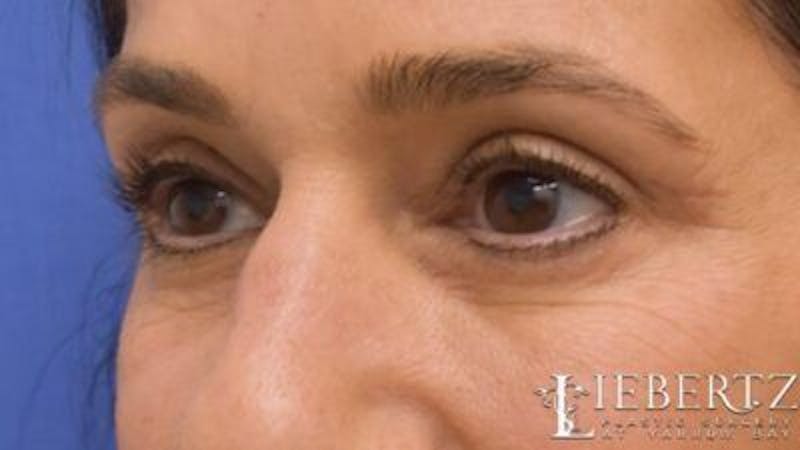 Blepharoplasty Before & After Gallery - Patient 320489 - Image 6