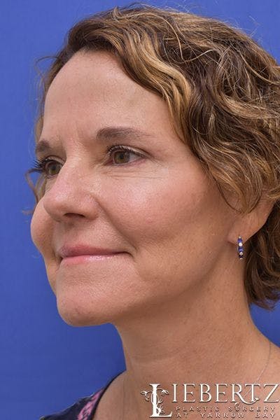 facelift