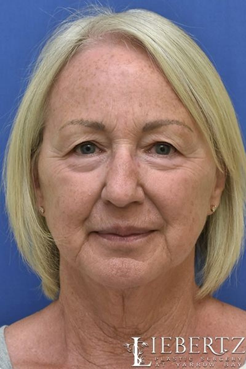 Blepharoplasty Before & After Gallery - Patient 273532 - Image 1