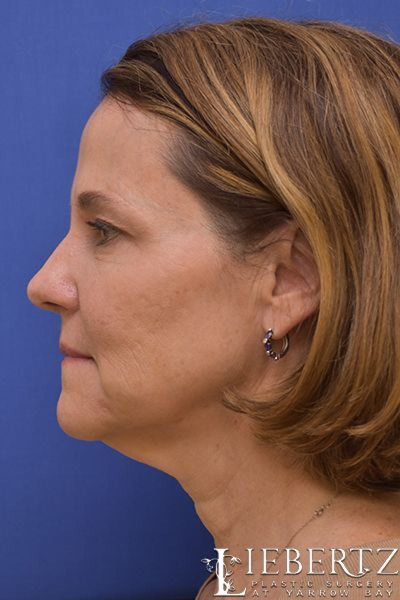 Facelift Before & After Gallery - Patient 390865 - Image 9