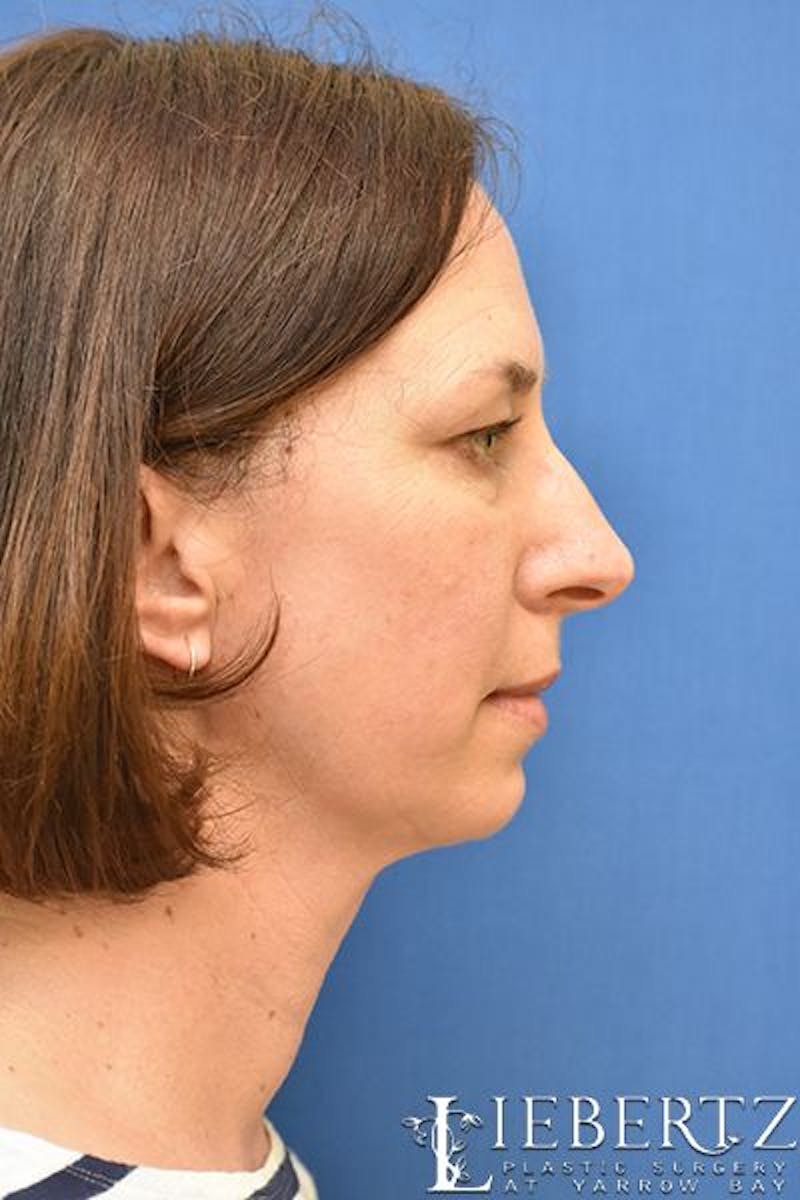 Dermal Fillers Before & After Gallery - Patient 295599 - Image 5