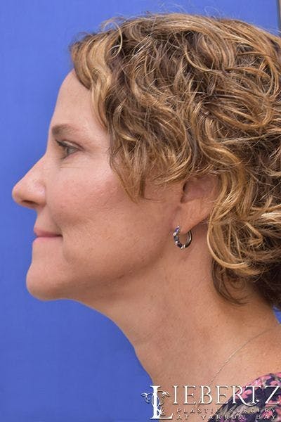 facelift