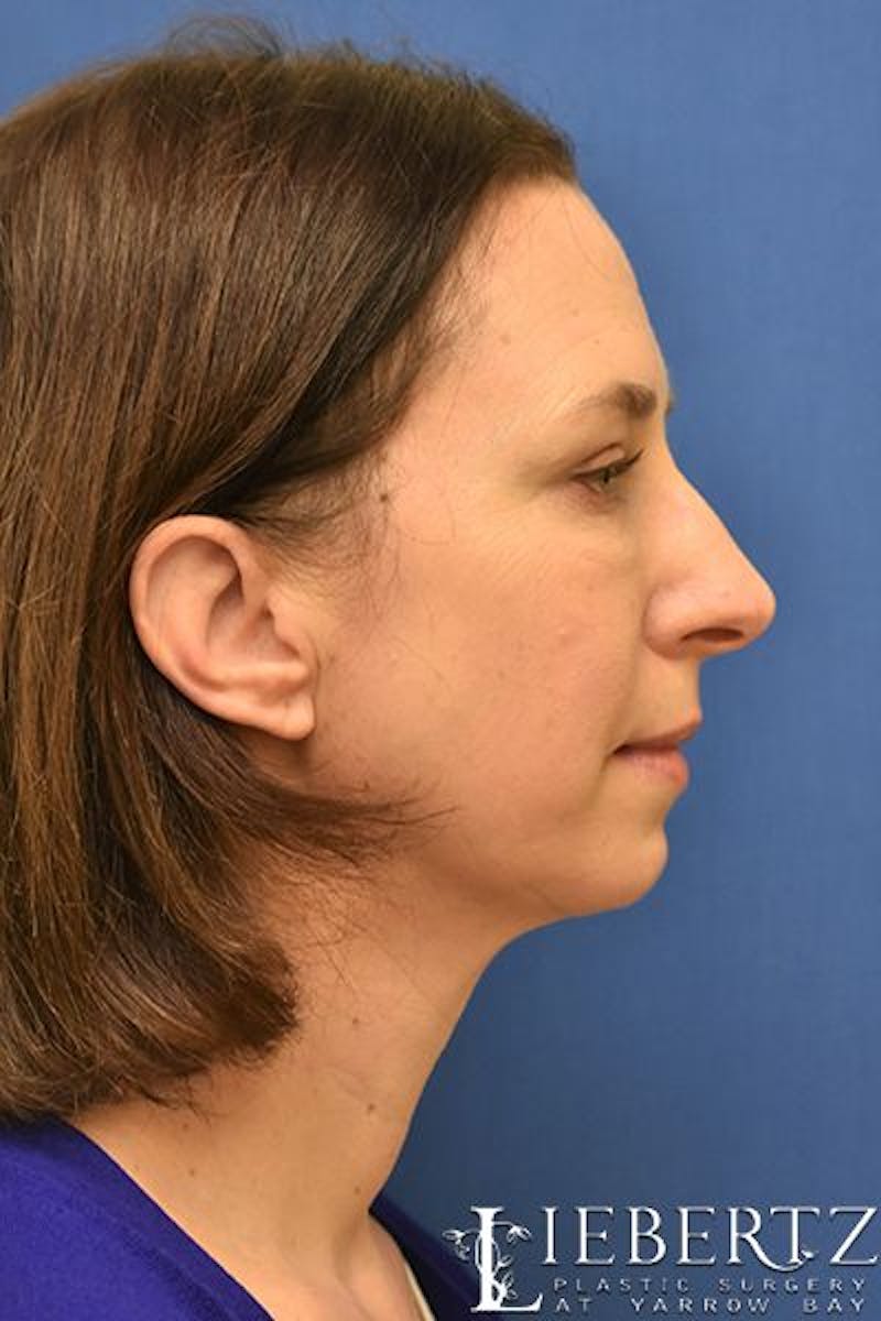 Dermal Fillers Before & After Gallery - Patient 295599 - Image 6