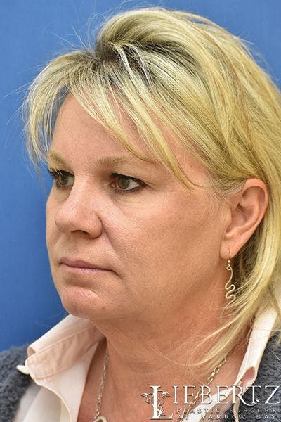 Facelift Before & After Gallery - Patient 228355 - Image 1