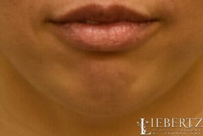 Dermal Fillers Before & After Gallery - Patient 375133 - Image 1