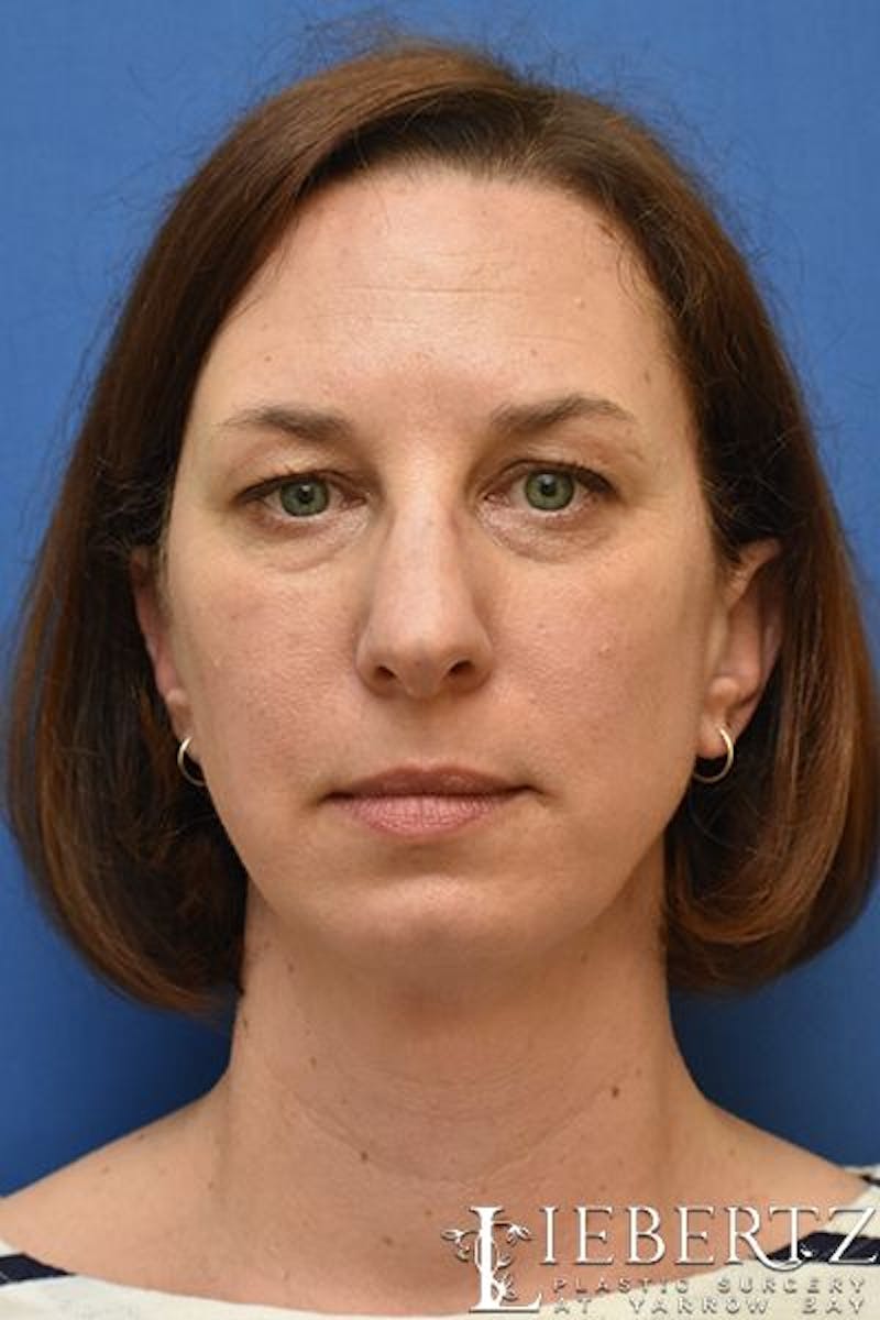 Blepharoplasty Before & After Gallery - Patient 324722 - Image 1