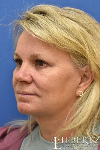 Facelift Before & After Gallery - Patient 228355 - Image 2