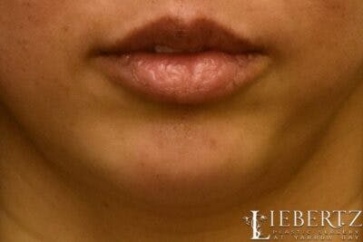 Dermal Fillers Before & After Gallery - Patient 375133 - Image 2