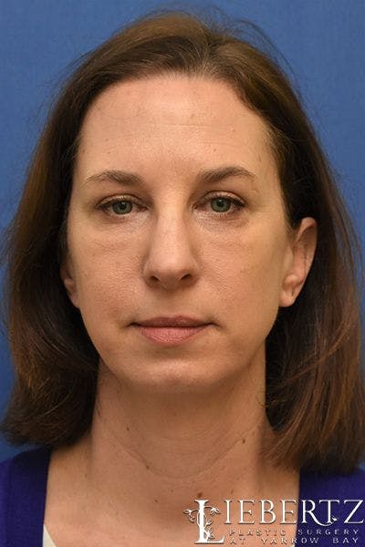 Blepharoplasty Before & After Gallery - Patient 324722 - Image 2