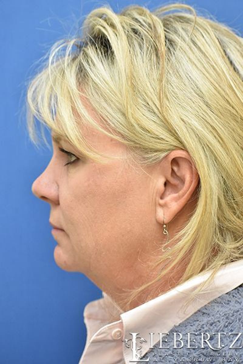 Facelift Before & After Gallery - Patient 228355 - Image 5