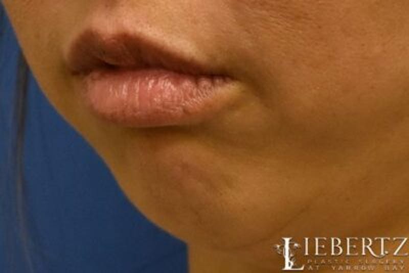 Dermal Fillers Before & After Gallery - Patient 375133 - Image 3
