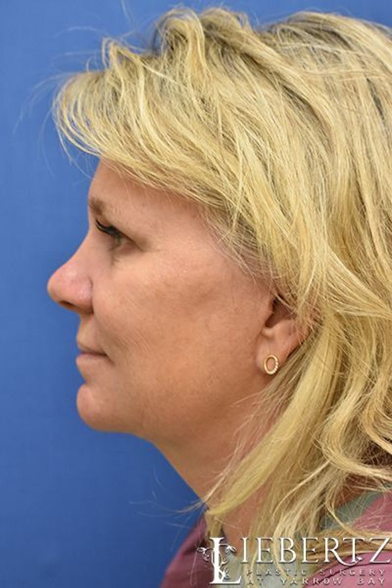 Facelift Before & After Gallery - Patient 228355 - Image 6