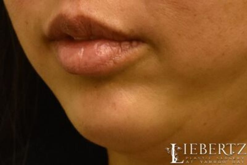 Dermal Fillers Before & After Gallery - Patient 375133 - Image 4