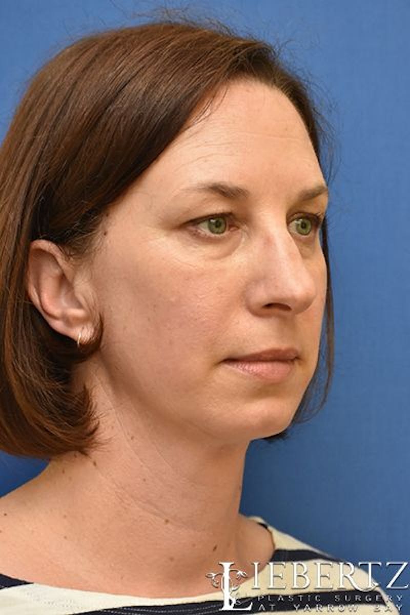 Blepharoplasty Before & After Gallery - Patient 324722 - Image 3