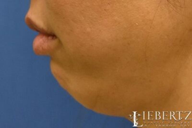 Dermal Fillers Before & After Gallery - Patient 375133 - Image 5