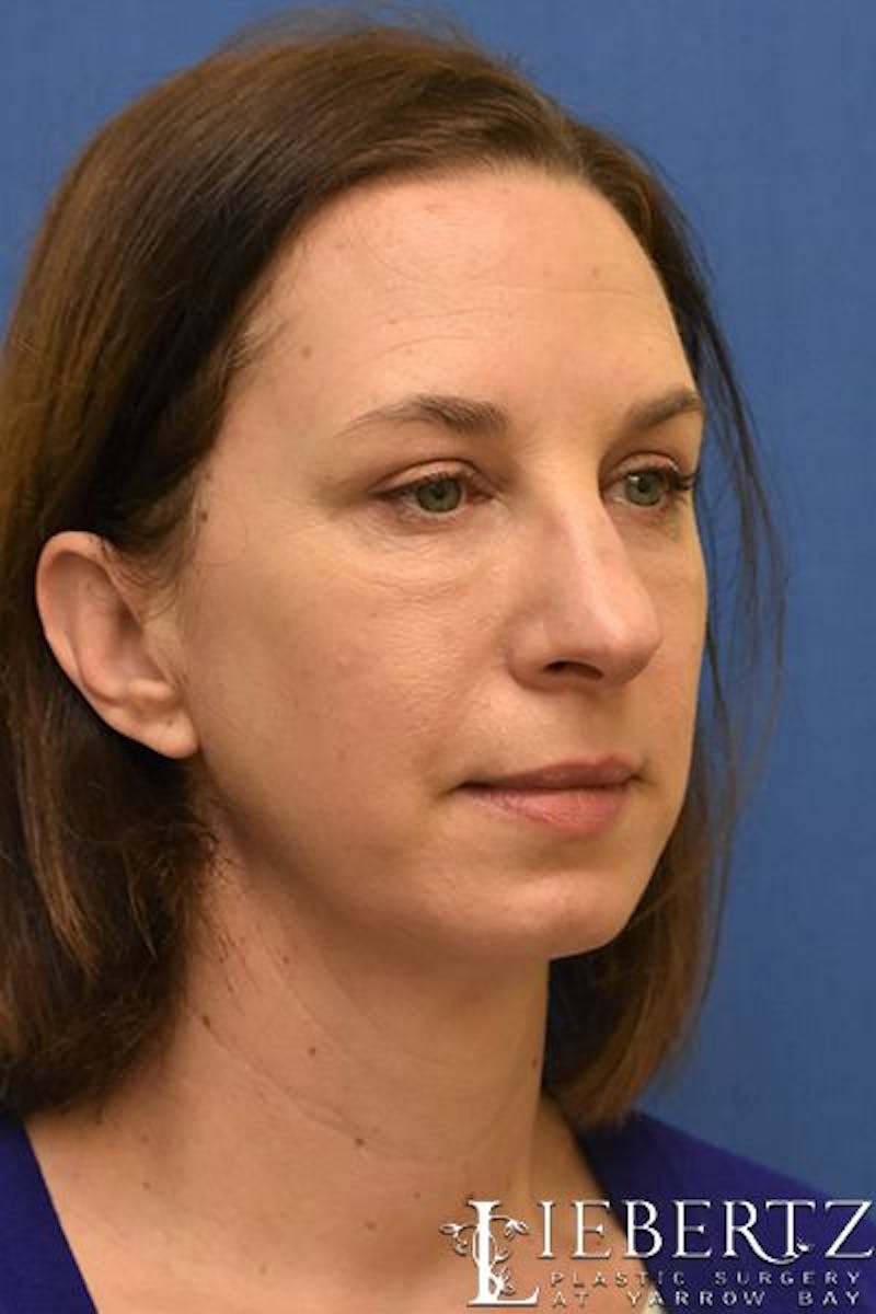 Blepharoplasty Before & After Gallery - Patient 324722 - Image 4