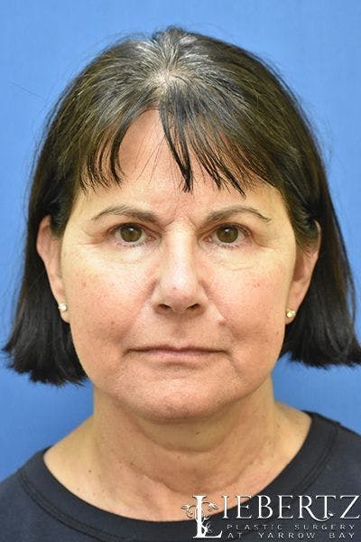 Facelift Before & After Gallery - Patient 214786 - Image 2